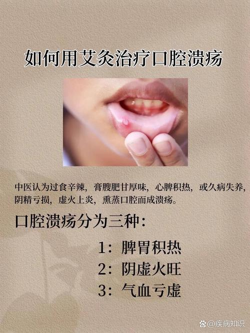 那个穴位能治疗口疮