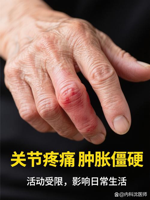 老人手关节类风湿治疗
