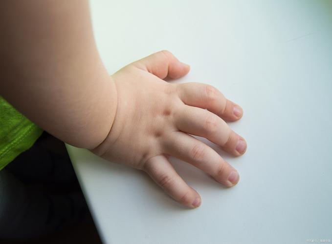 幼儿类风湿全身型长大