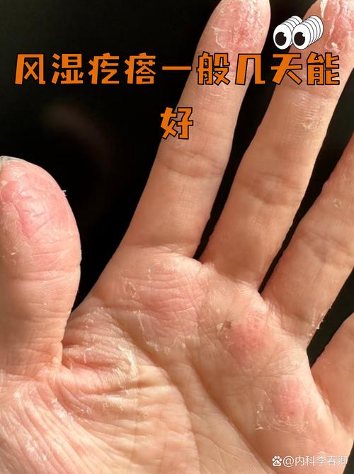 风湿疙瘩不吃药能好吗