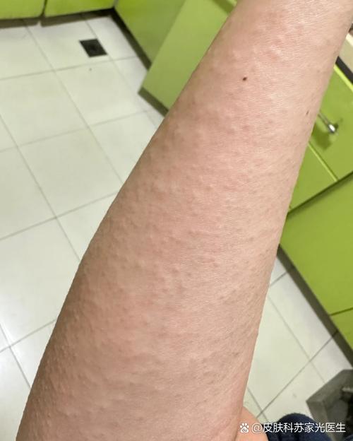 风湿疙瘩不吃药能好吗