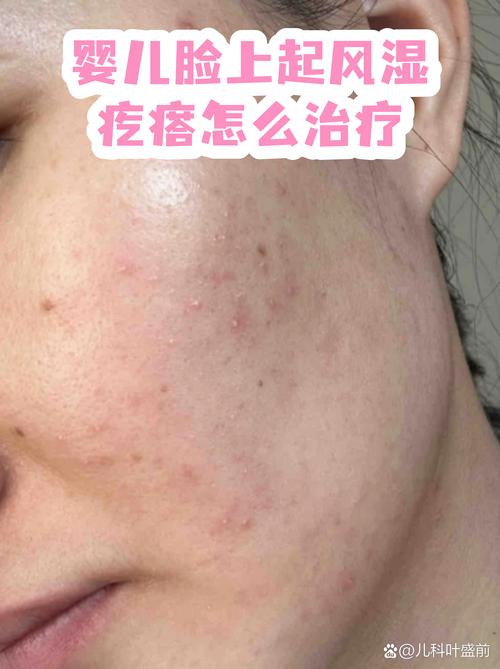 婴儿风湿疙瘩注意事项