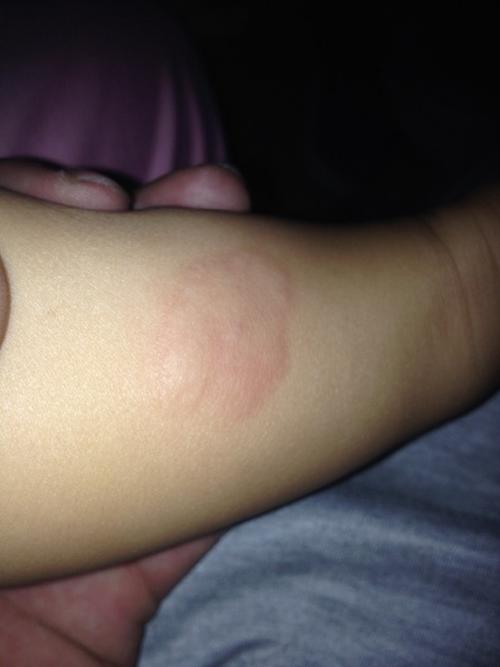 婴儿风湿疙瘩注意事项