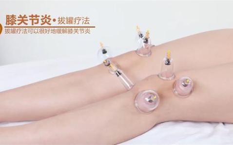 风湿膝盖痛火罐拔哪里