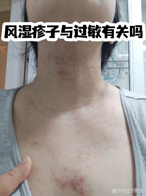 风湿关节疙瘩怎么回事