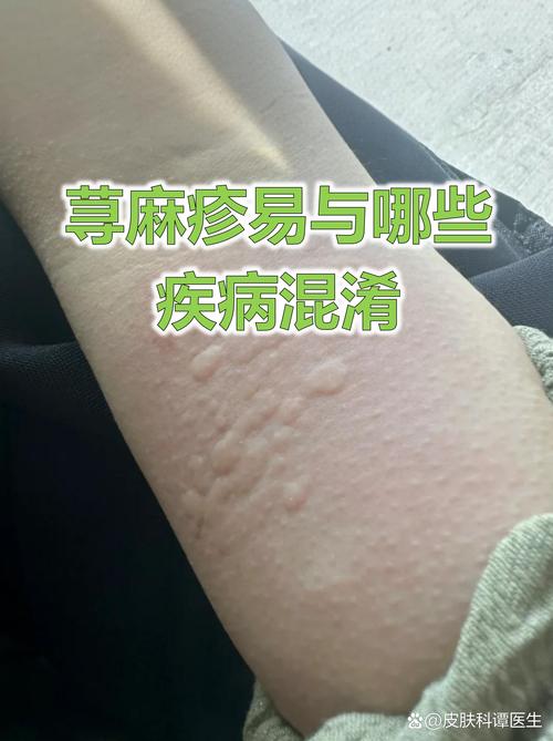 过敏免疫风湿科是什么