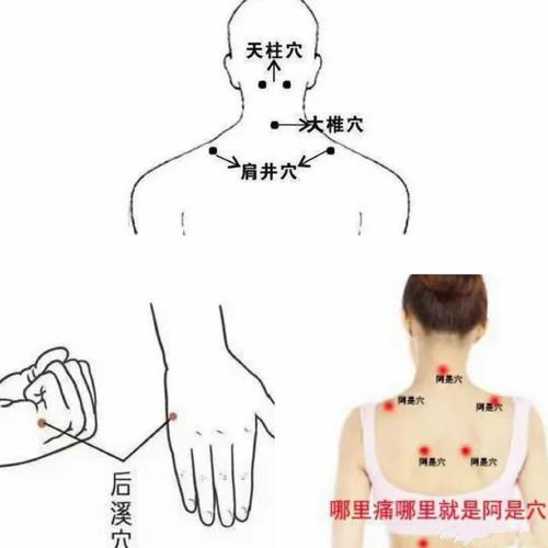 颈椎增生按摩啥穴位