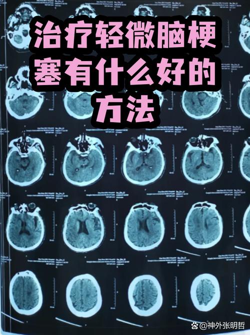 早期轻微脑梗能治好吗