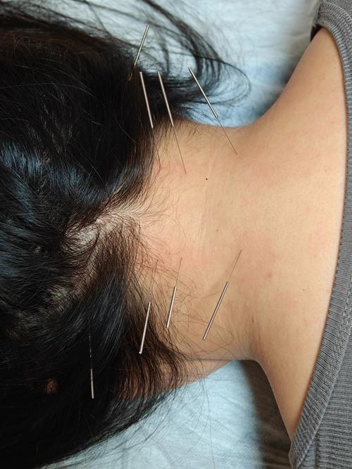 禁止针灸的致命穴位