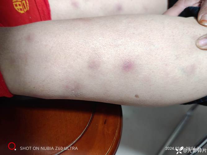 类风湿皮下结节是什么