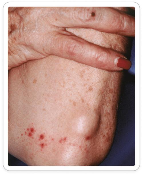 类风湿皮下结节是什么