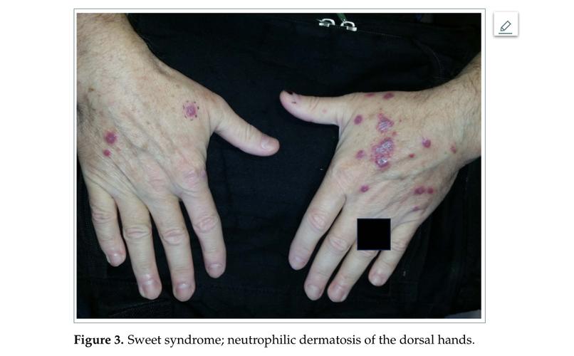 类风湿皮下结节是什么