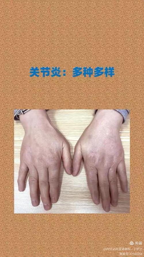 人有风湿会有哪些症状