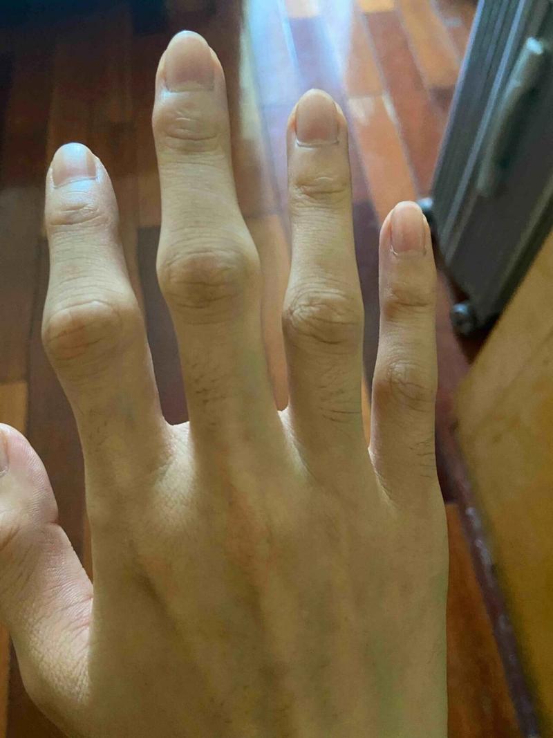 内风湿有哪些症状图片