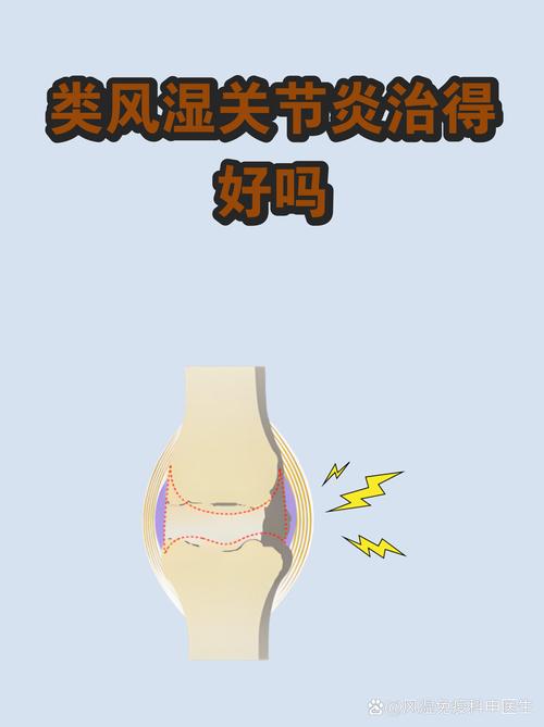 大连治类风湿哪里最好