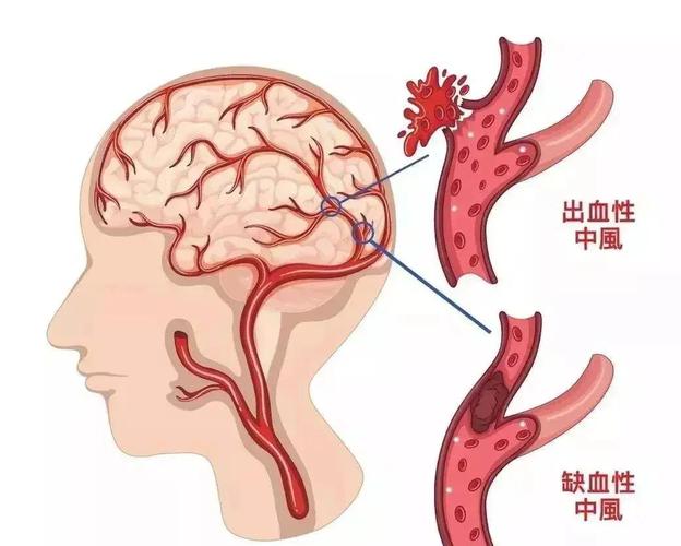 严重脑梗的症状有哪些