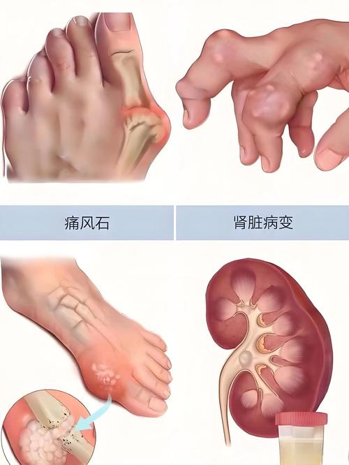 体内有风湿因子的症状