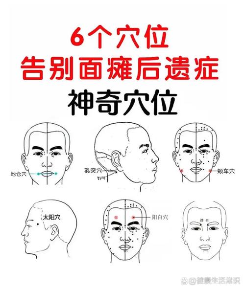 面瘫治疗针灸穴位图