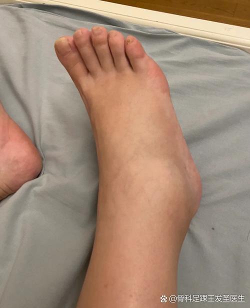 脑梗病人脚肿怎么回事