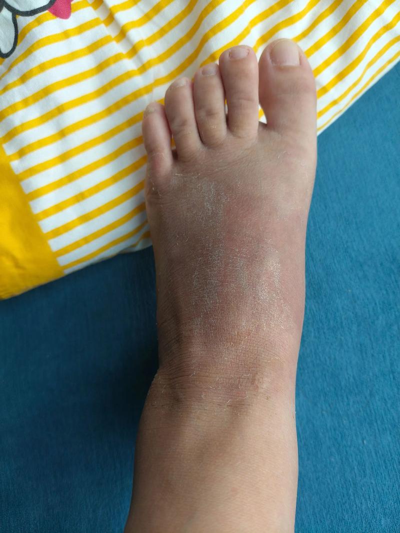 初期游走性风湿的症状