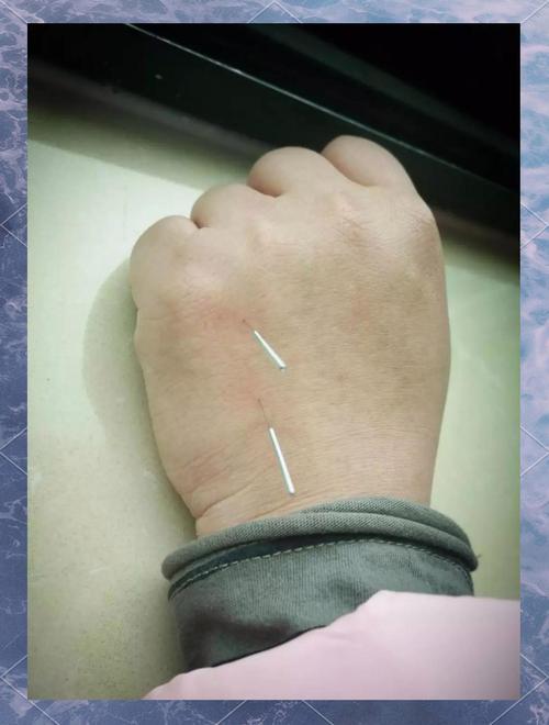 急性痛风的针灸穴位