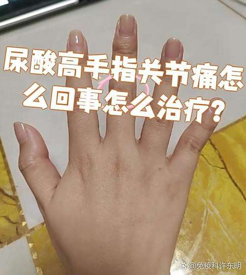 双手手指涨痛 类风湿