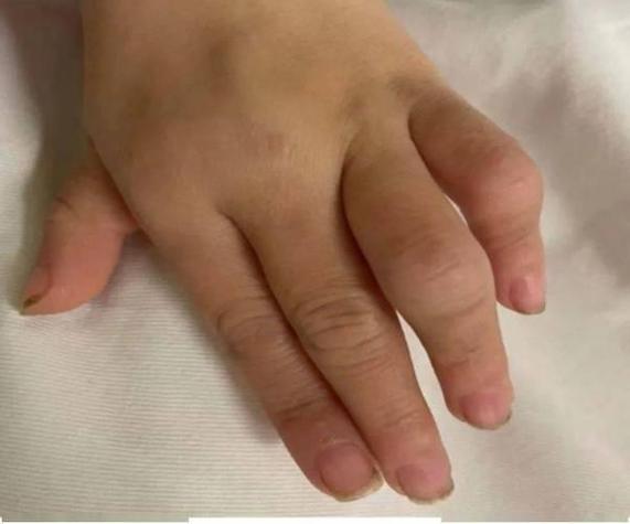 严重幼年类风湿的症状