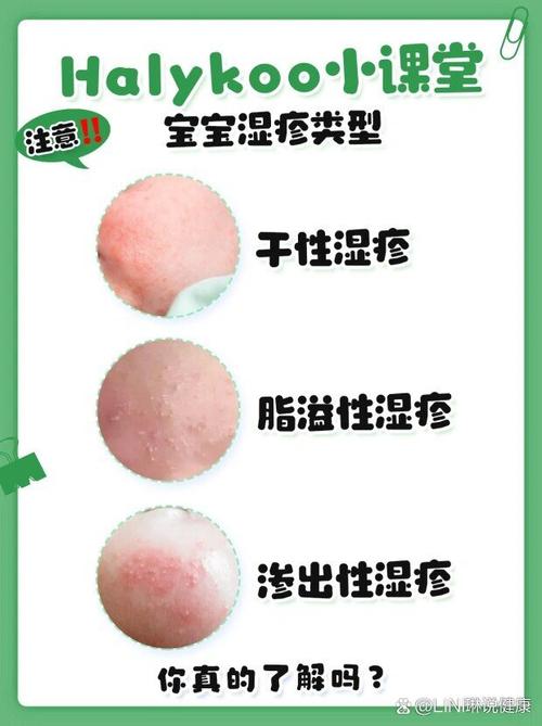 婴儿干燥型湿疹穴位