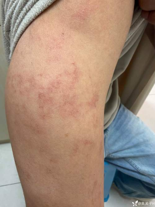 胳膊类风湿有什么症状