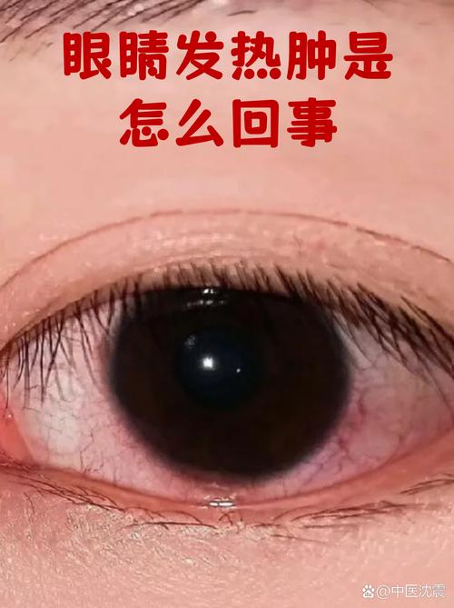 脑梗压迫眼睛能恢复吗