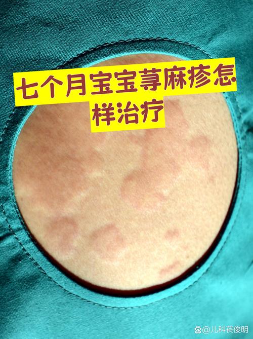 幼儿类风湿是什么症状