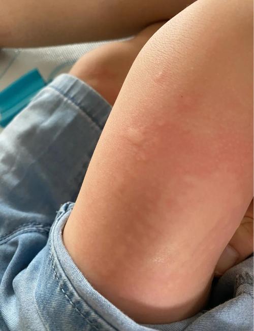 幼儿类风湿是什么症状