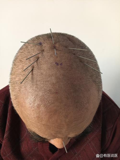 斑秃的治疗针灸穴位