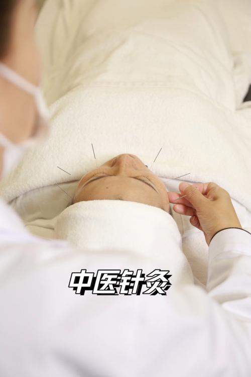 斑秃的治疗针灸穴位