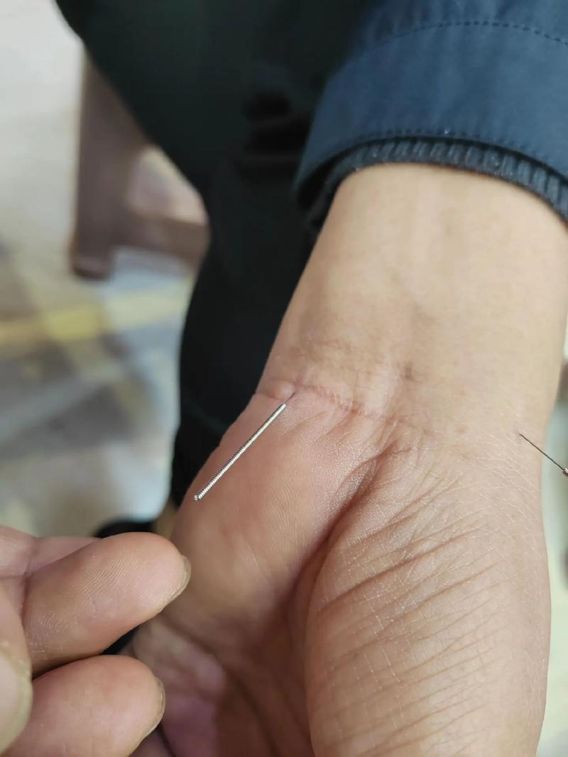 斑秃的治疗针灸穴位