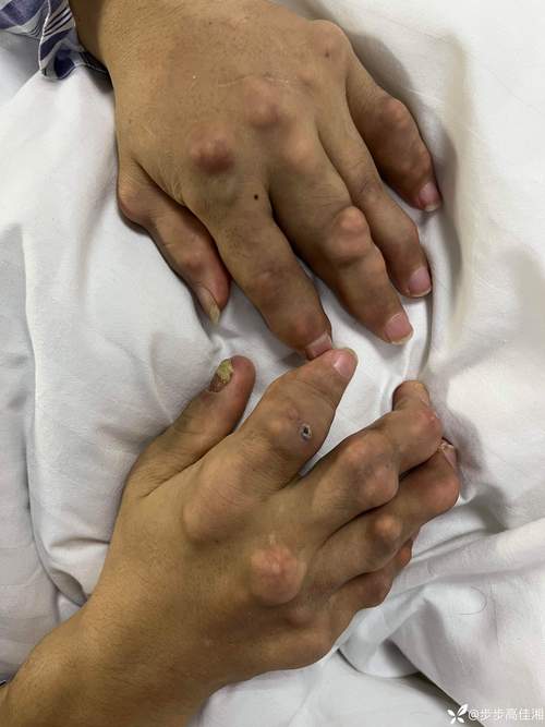 深圳宝安中心医院风湿