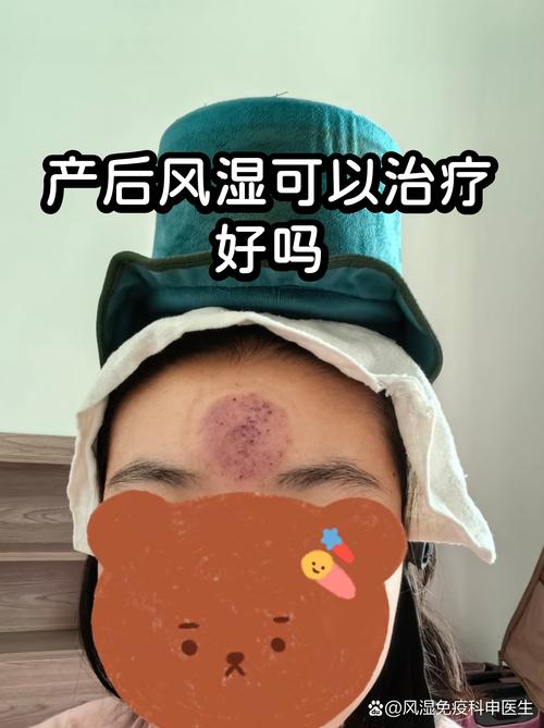 产后类风湿可以治好吗