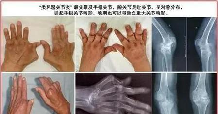 类风湿小结的病理改变