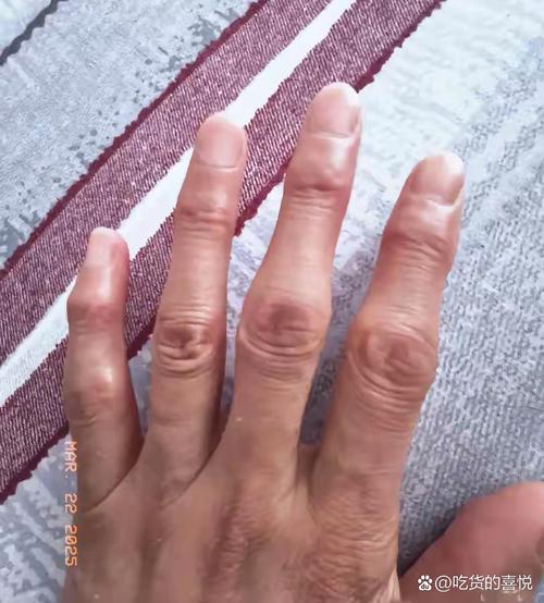 类风湿晚期变形手图片