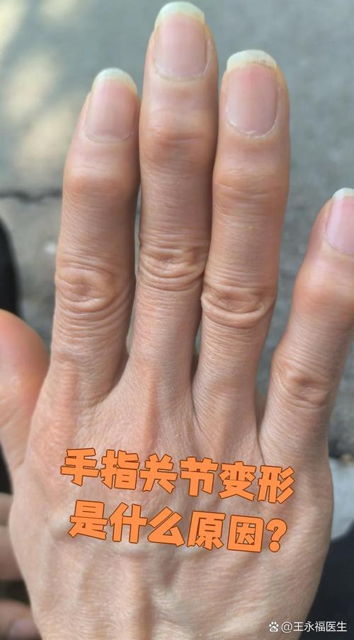 类风湿晚期变形手图片