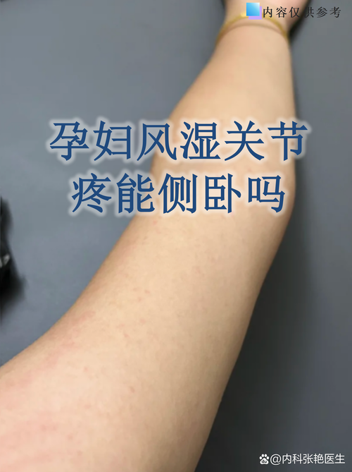 风湿疙瘩不能喝牛奶吗