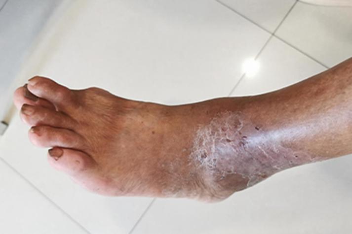 广州东方类风湿专科黑