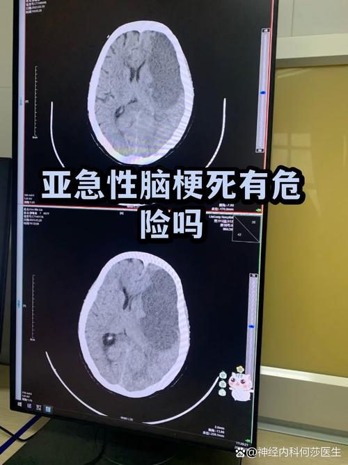 急性脑梗有生命危险吗