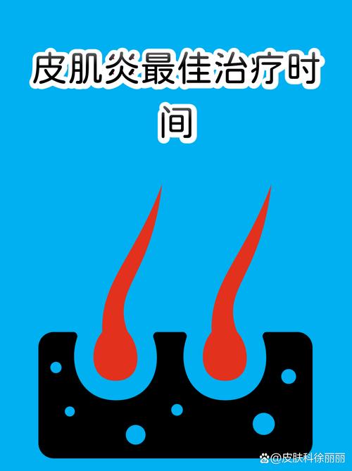 风湿性皮肌炎能否治好