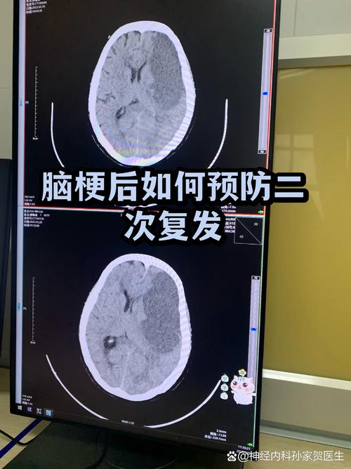 脑梗多久容易二次复发