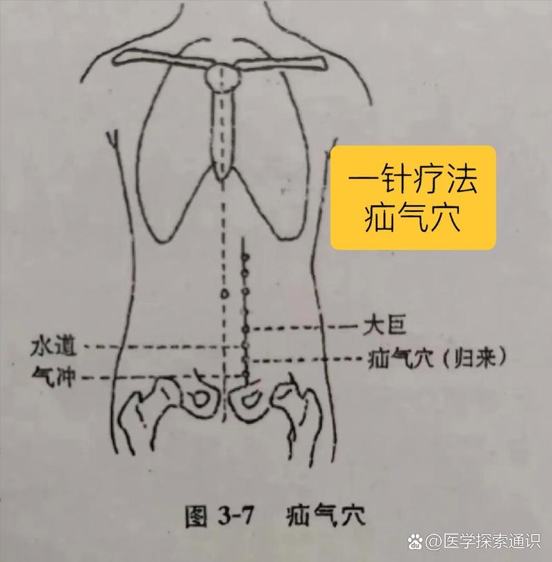 艾灸治疗疝气 穴位