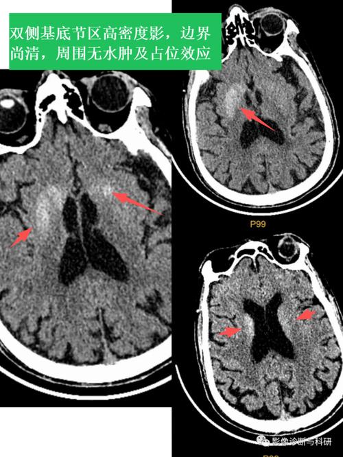 脑梗 增强核磁表现