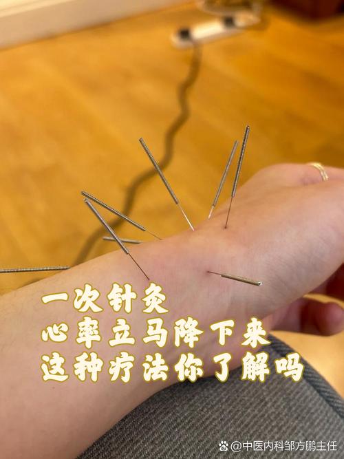 针灸治疗多动症穴位